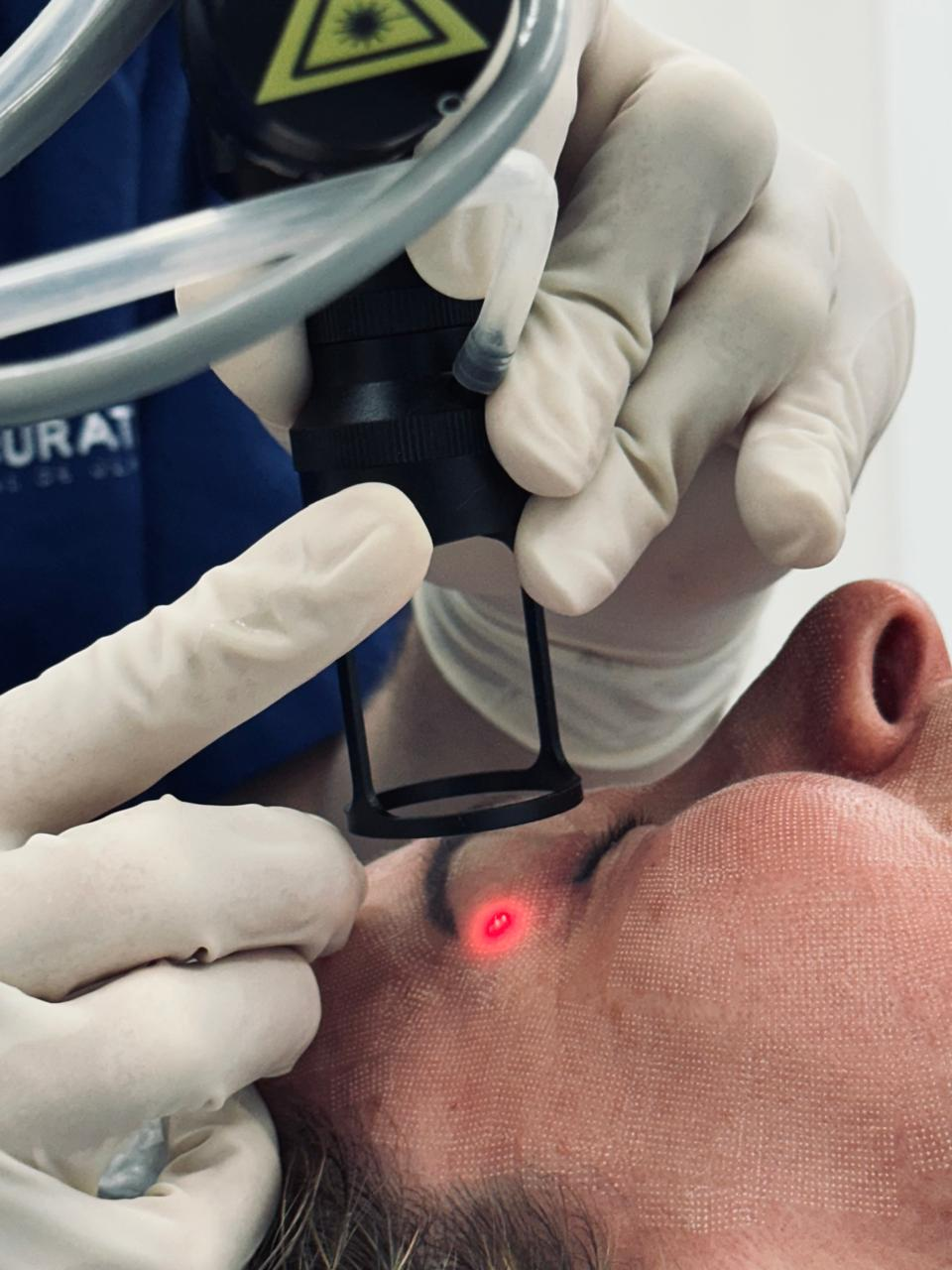 Laser C02 palpebras.png