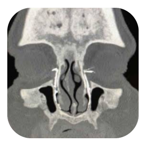 Blefaroplastia com laser de CO2 (3).png