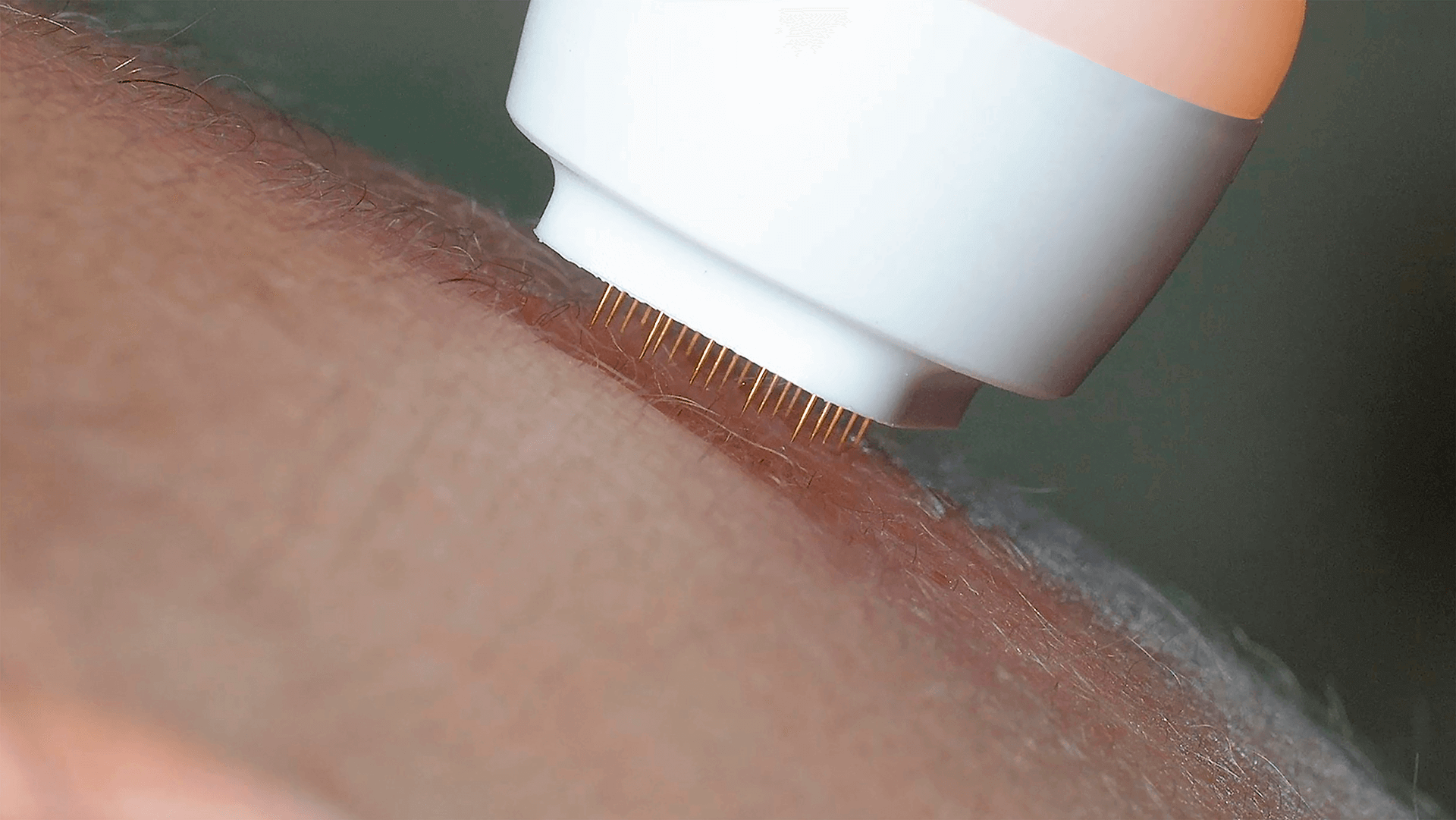 Radiofrequência fracionada.png